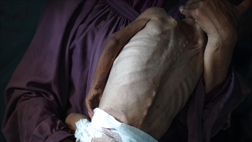 İsrail'in Kıtlığı Dayattığı Gazze'de Son 24 Saatte 1'I Çocuk 6 Kişi Daha Açlıktan Hayatını Kaybetti (2)